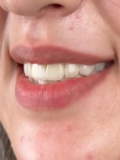 Le même sourire après traitement : dents blanches et harmonieuses