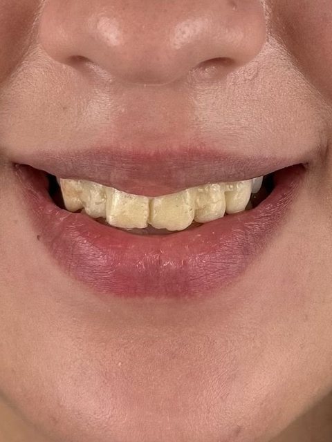 Sourire avant traitement : dents colorées et usées