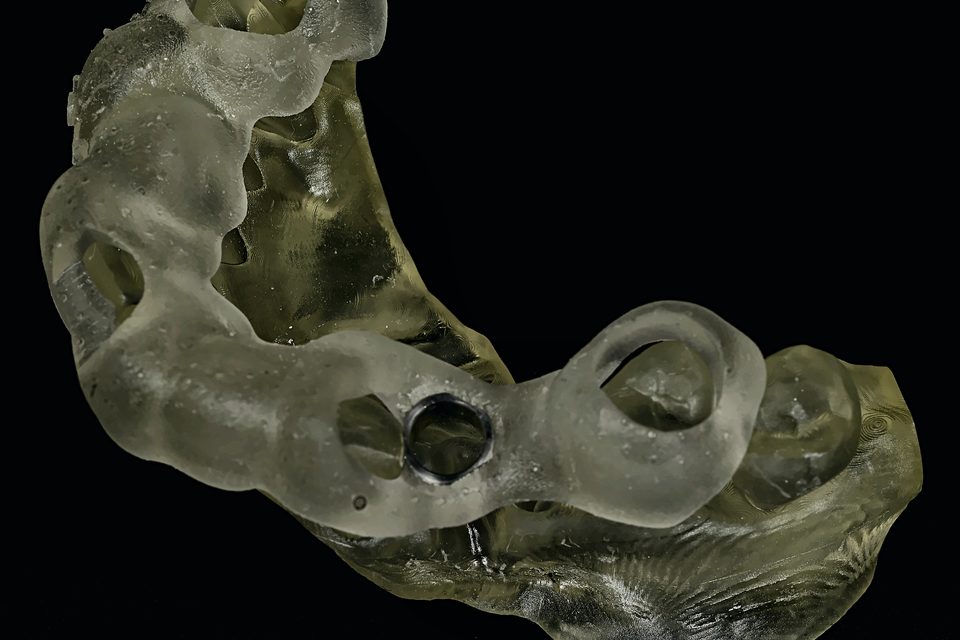 Guide chirurgical pour implants posé sur un modèle 3D