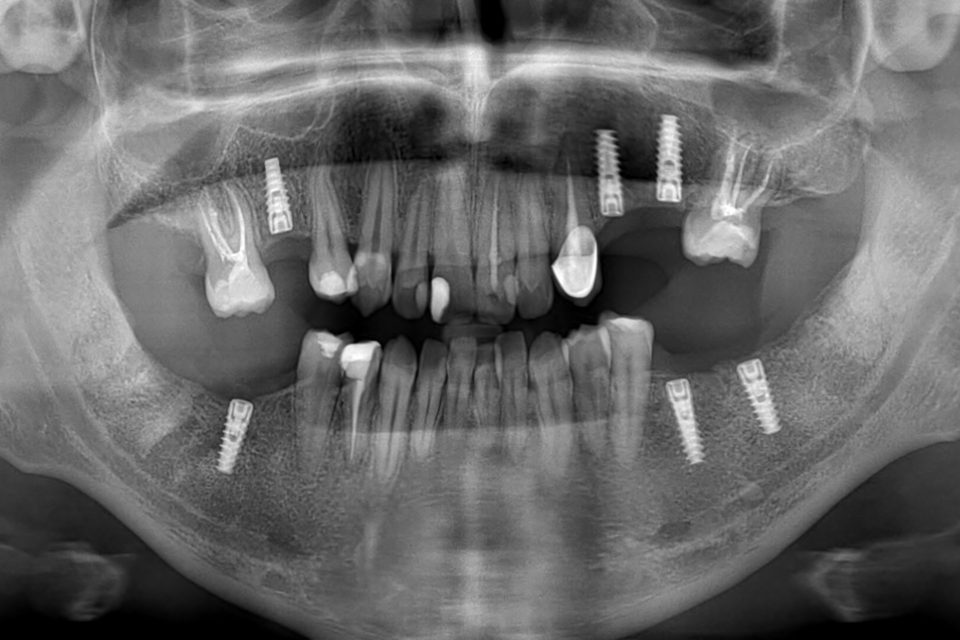 Radiographie panoramique montrant plusieurs implants dentaires