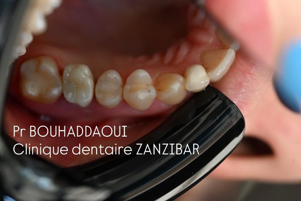 Dents du côté droit après un traitement par implant unitaire, photographiées au miroir