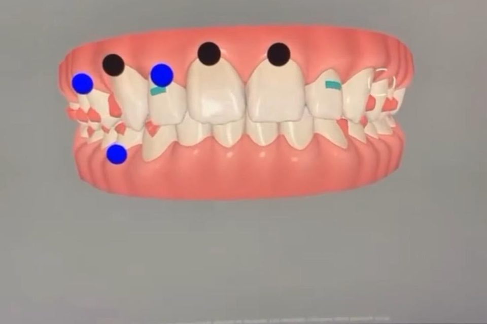 Simulation numérique 3D d’un traitement par aligneurs