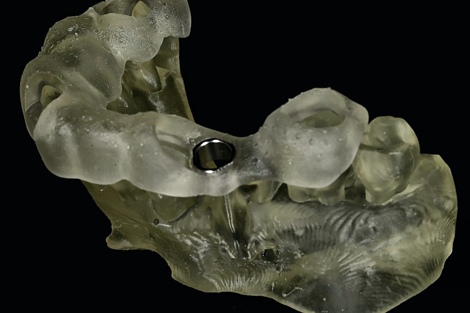 Guide implantaire sur le modèle 3D, autre vue