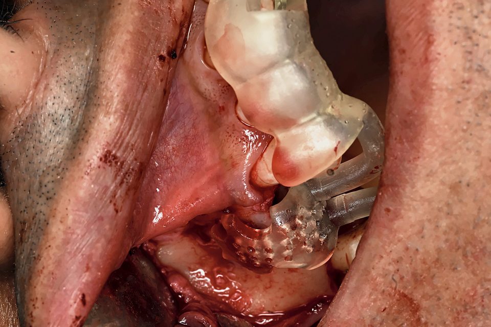 Guide de greffe osseuse en place en bouche